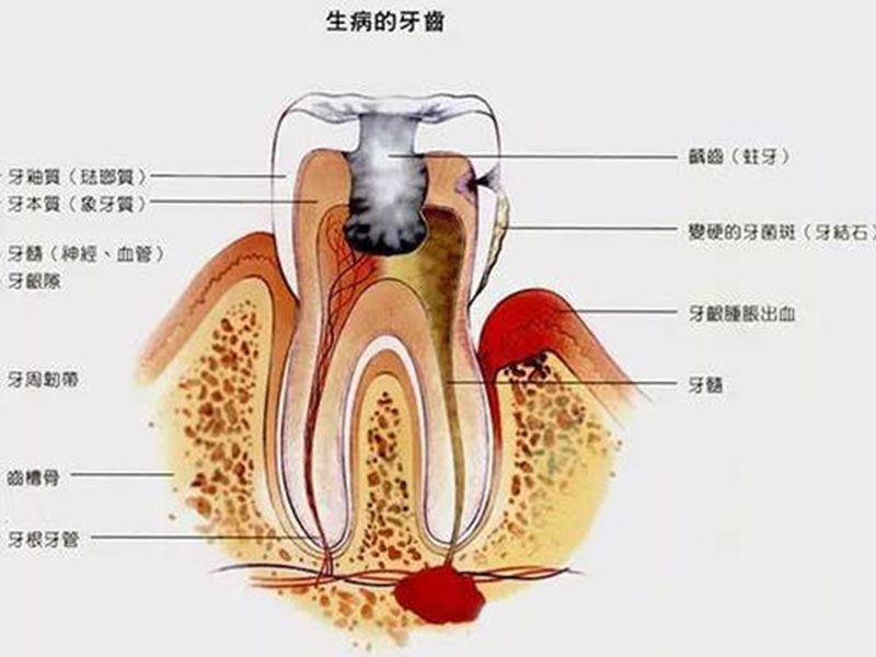 牙髓炎