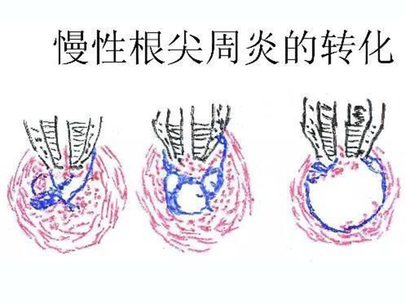 菏泽口腔医院讲解痛起来要命的牙痛，到底怎么办？