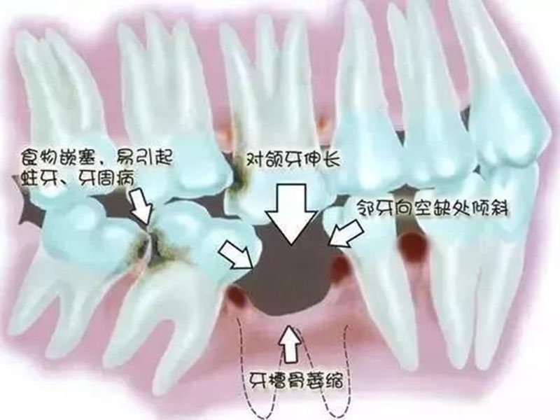 【口腔科普】种植牙的问题，现在为你一 一解答！