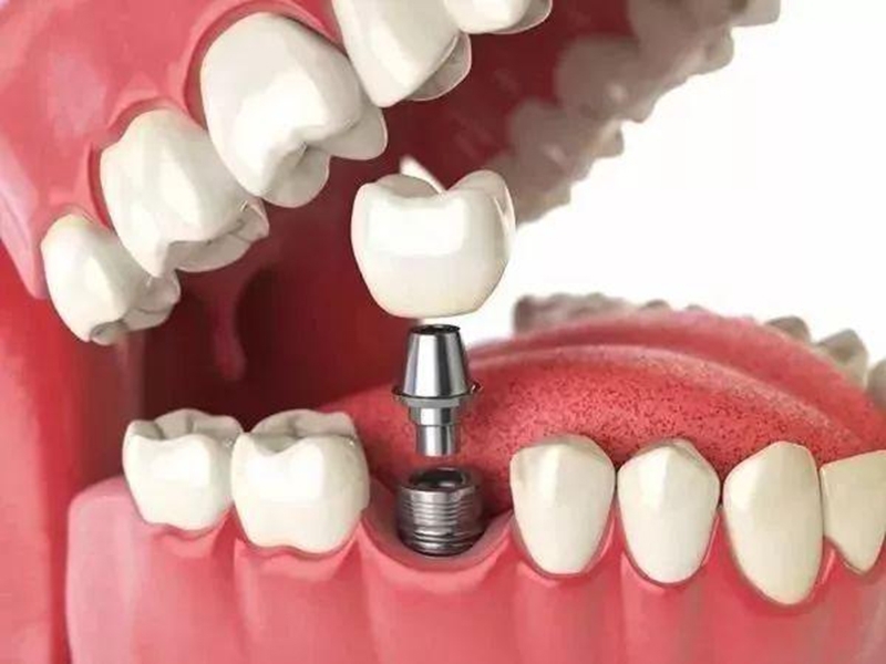 镶牙和植牙有什么不同？