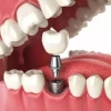 镶牙和植牙有什么不同？